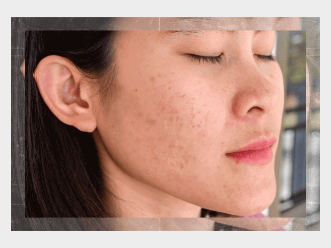 Large Pores on Face: Top Treatment Products