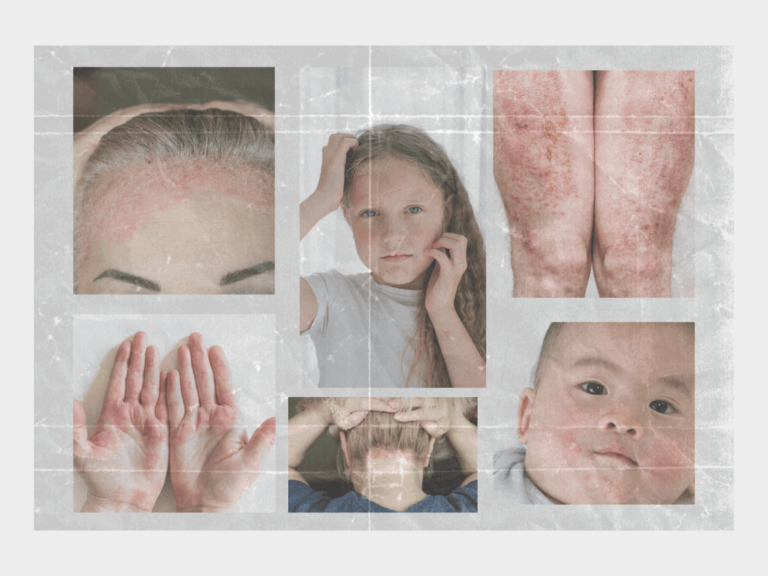 Eczema: Causes, Symptoms, and Care