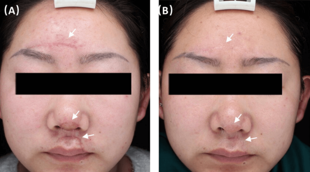 effective scar laser treatment before and after 