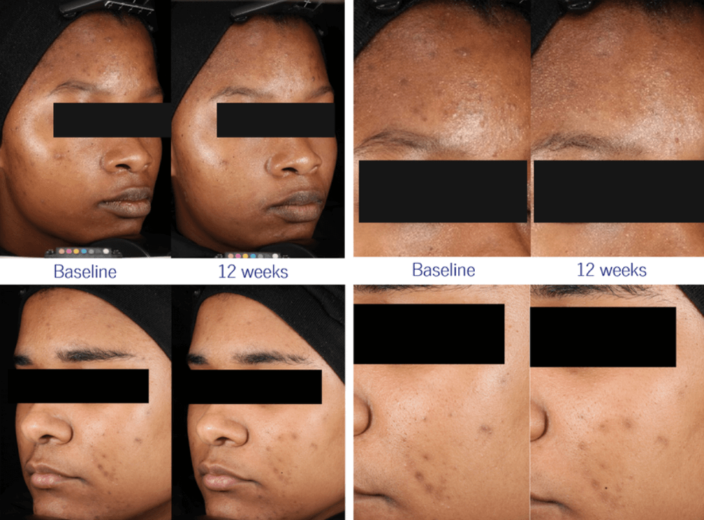 Effective hyperpigmentation Scar Treatment