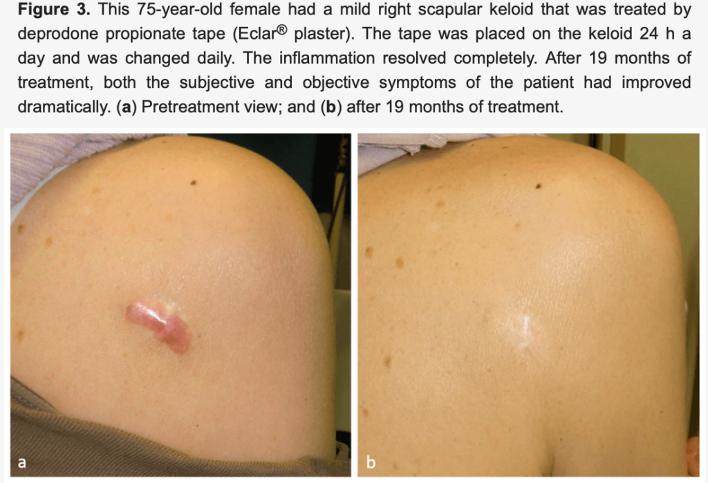 effective keloid scar treatments before and after